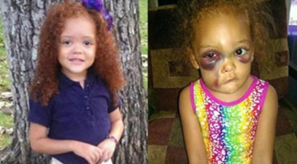 Miss. Kindergartner Brutally Attacked by Child at School Playground, Mom Says